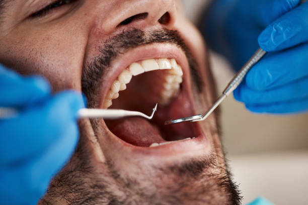 Best Emergency Wisdom Teeth Removal in Gordon, PA